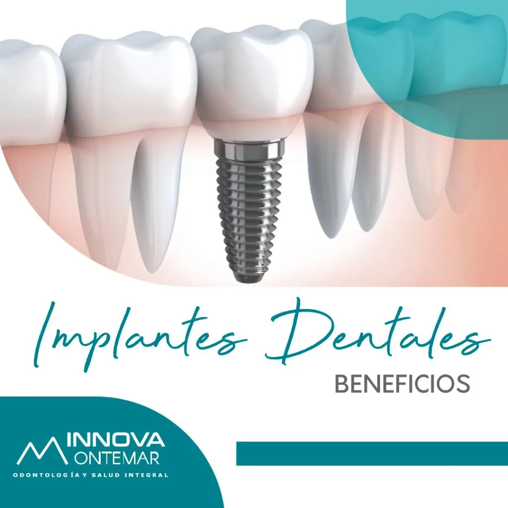 imagen 3d de implante dental en medio de otras muelas