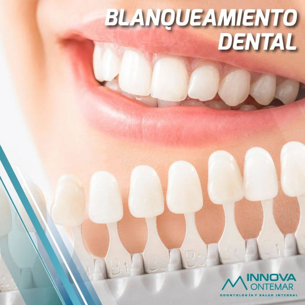 imagen de mujer sonriendo junto a carillas dentales