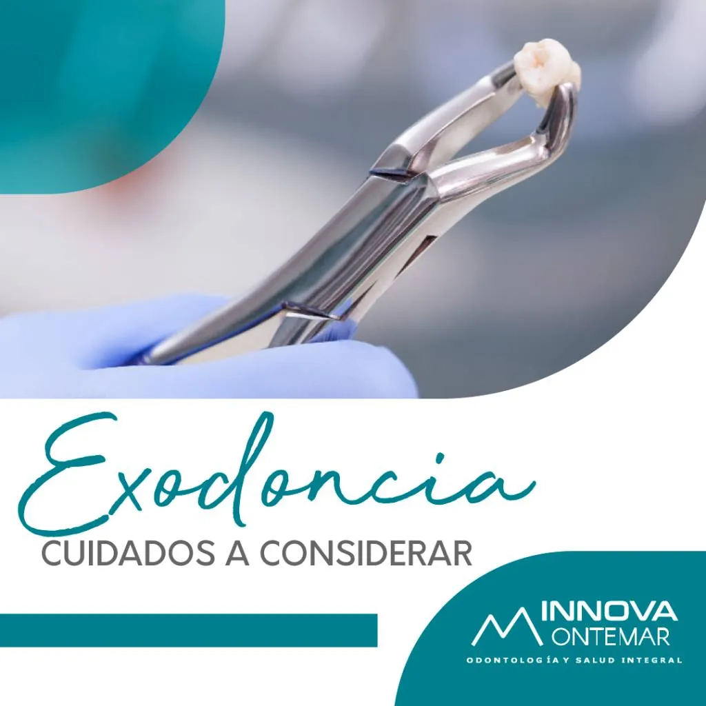 imagen de muela siendo extraída