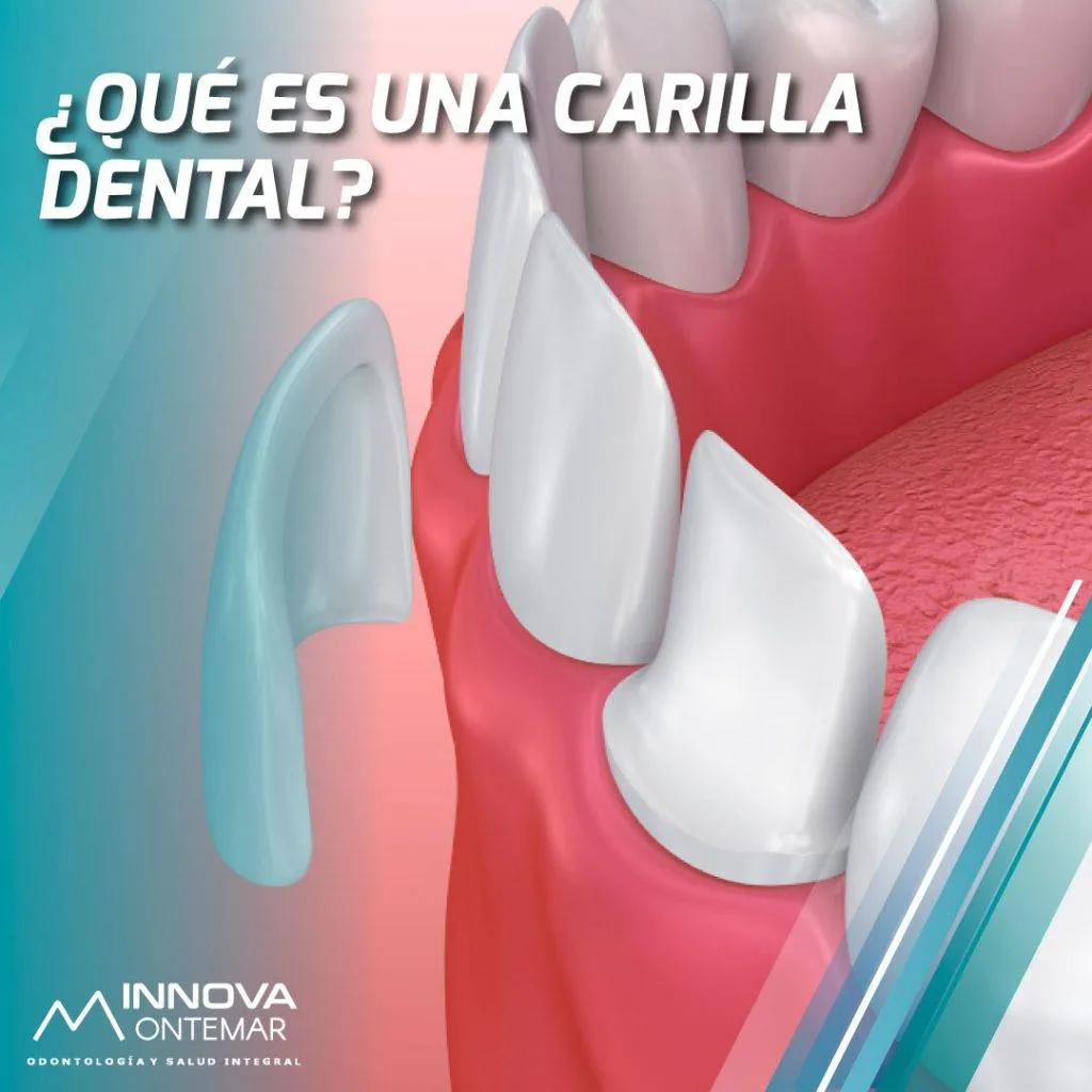 imagen 3d de carillas dentales siendo aplicadas a una dentadura