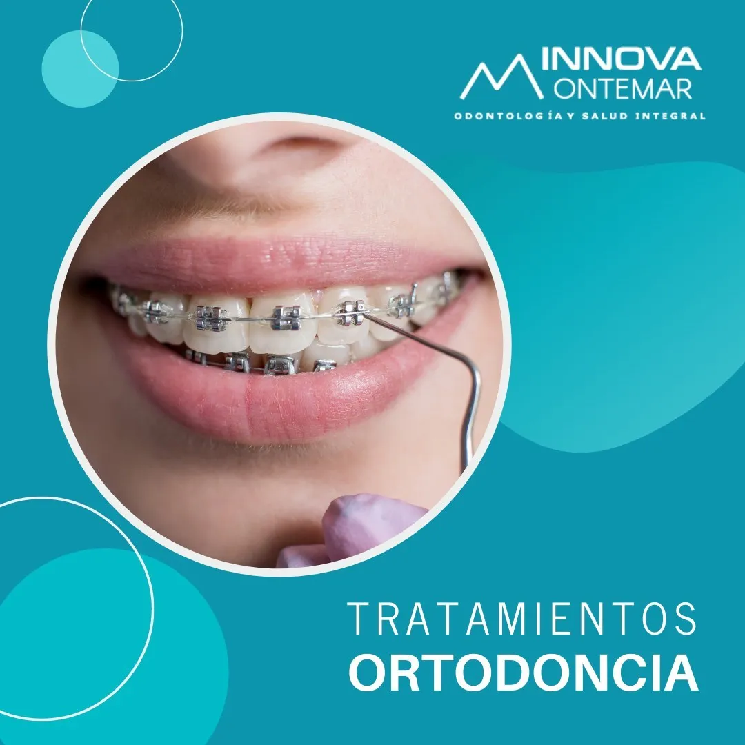 imagen de mujer con brackets dentales
