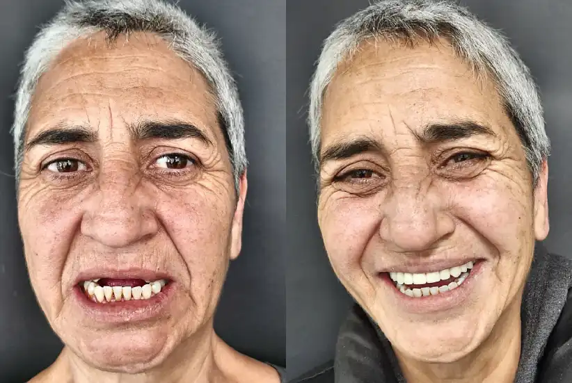 antes-despues-02-optimized
