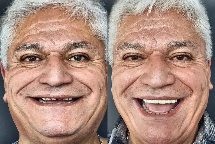 antes-despues-04-optimized